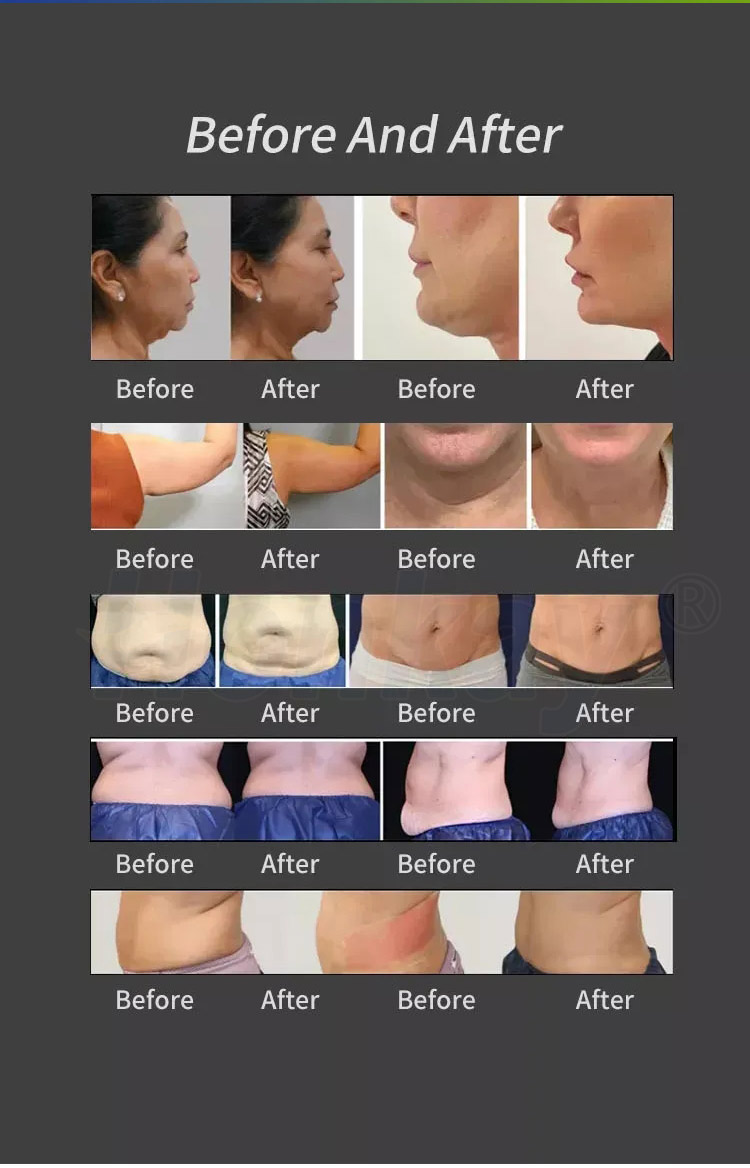 before after trusculpt